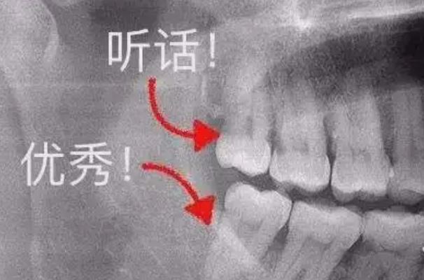 智齿怎么长是正确位置